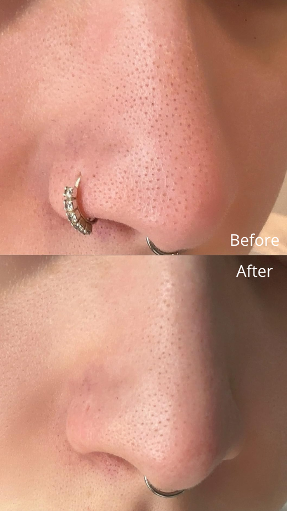 Nose Plant Pore Strips – Blackhead Remover
