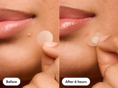 Invisible Pimple Patches (36) — For Whiteheads